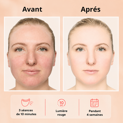 Masque LED Visage Zenoza - Anti-âge, Anti-acné